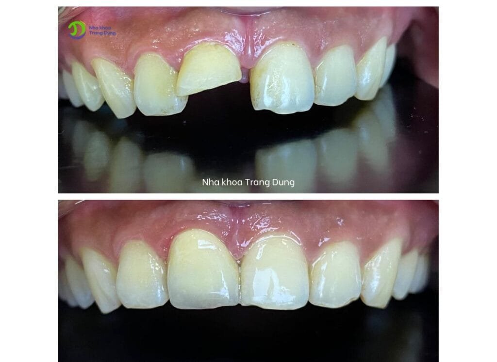 Ảnh trước và sau hàn răng cửa bị mẻ