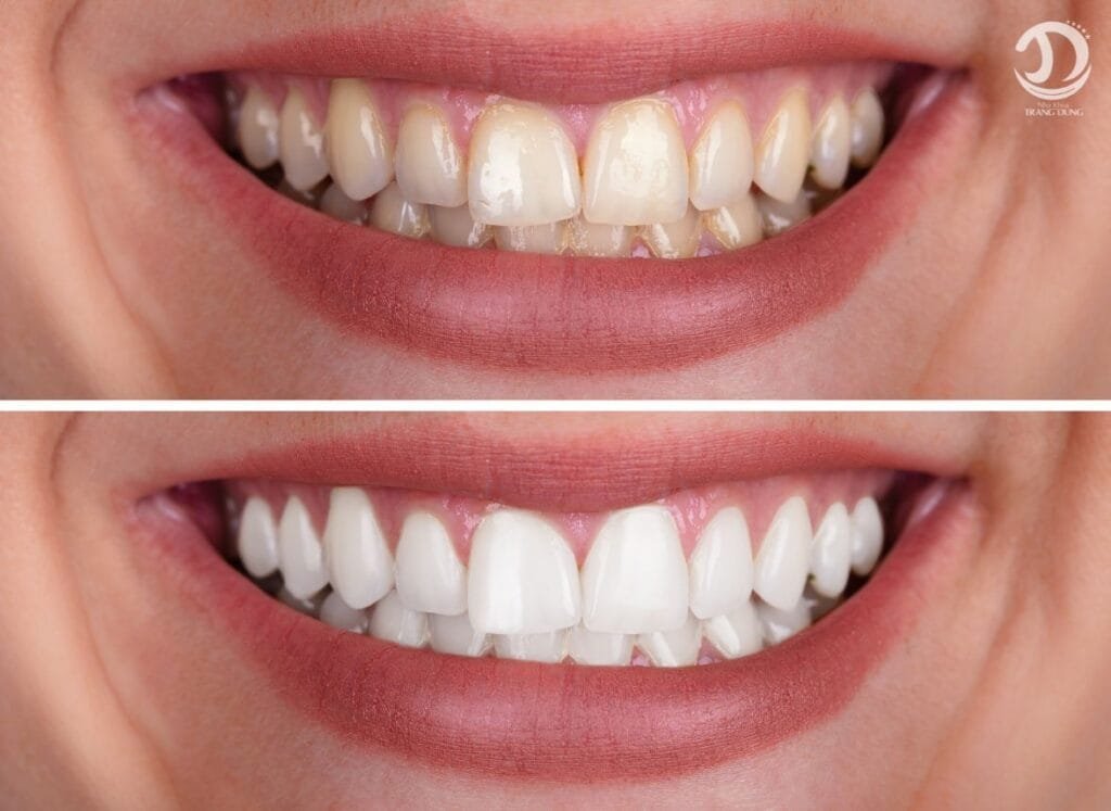 Ảnh trước và sau tẩy trắng răng