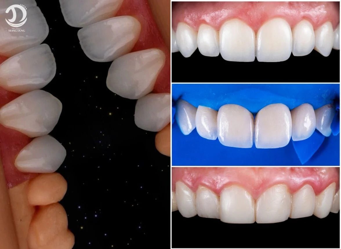 Ảnh cận cảnh mặt dán và các bước thử veneer từ website Trang Dung