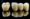 Tuổi thọ bọc răng sứ kim loại khoảng từ 5 đến 7 năm