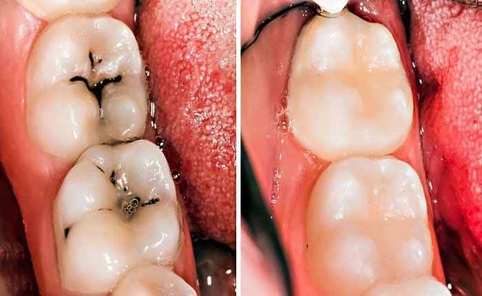 bọc răng sứ khi điều trị tủy