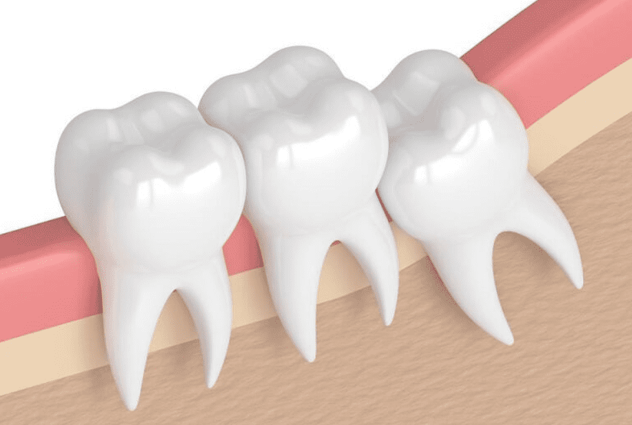 Nhổ răng khôn cần kiêng gì