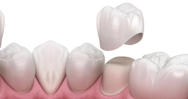 bọc răng sứ khi điều trị tủy