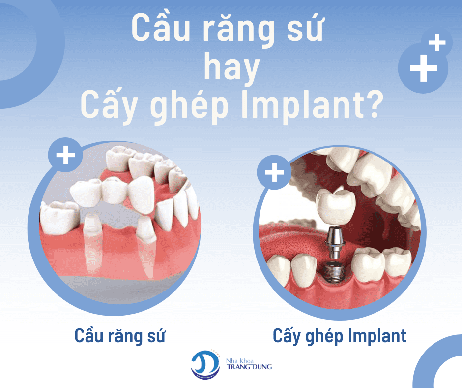 Cầu răng sứ hay cấy ghép implant