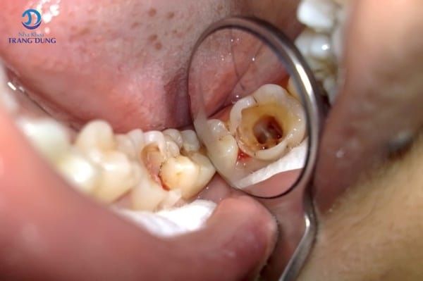 Bệnh nhân còn chân răng có bị tiêu xương không câu trả lời có  
