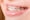 Niềng răng một hàm là gì?
