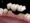 Trồng 3 răng liên tiếp bằng kỹ thuật răng sứ bắc cầu 