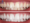 Tẩy trắng răng giữ được từ 6 tháng đến 3 năm 