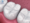 Trám răng Composite 