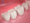 Trám răng Composite  có màu sắc như răng thật
