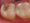 Trám răng Composite có tuổi thọ cao