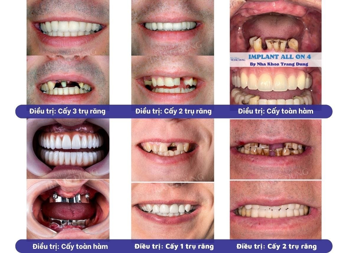 Trồng răng hàm implant giá bao nhiêu