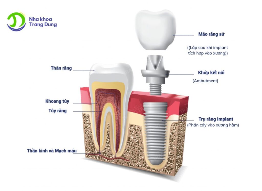 Cấu trúc trụ răng impalnt