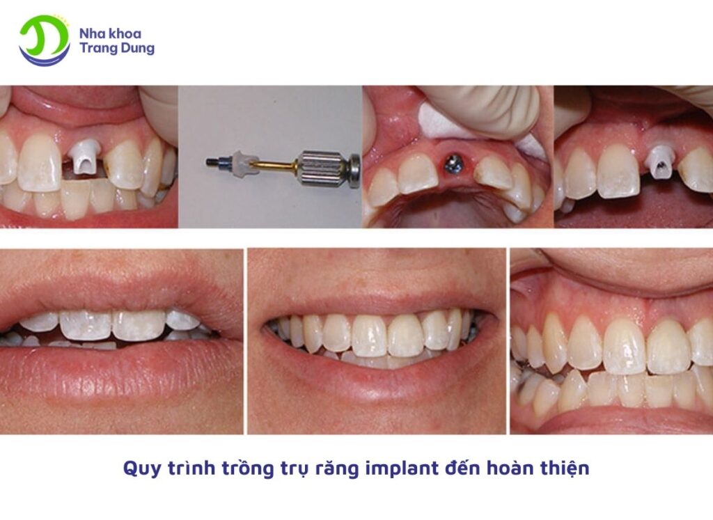 Quy trình cấy trụ răng implant