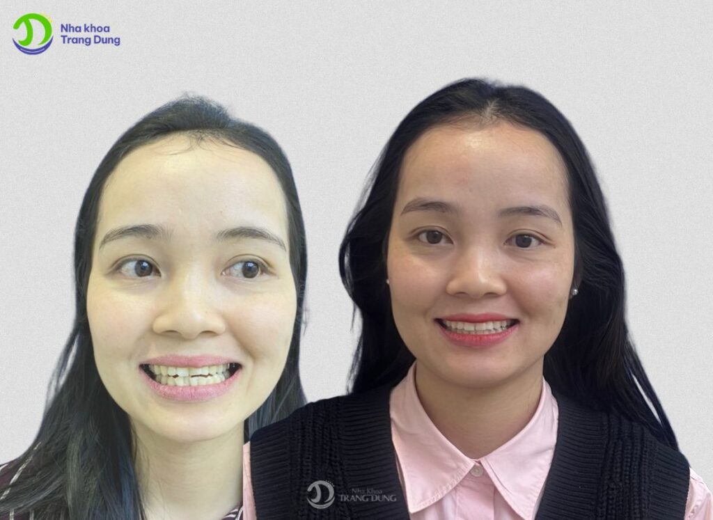 Ảnh trước và sau khách hàng niềng răng khay trong future smile tại nha khoa Trang Dung - nha khoa Trần Hưng Đạo