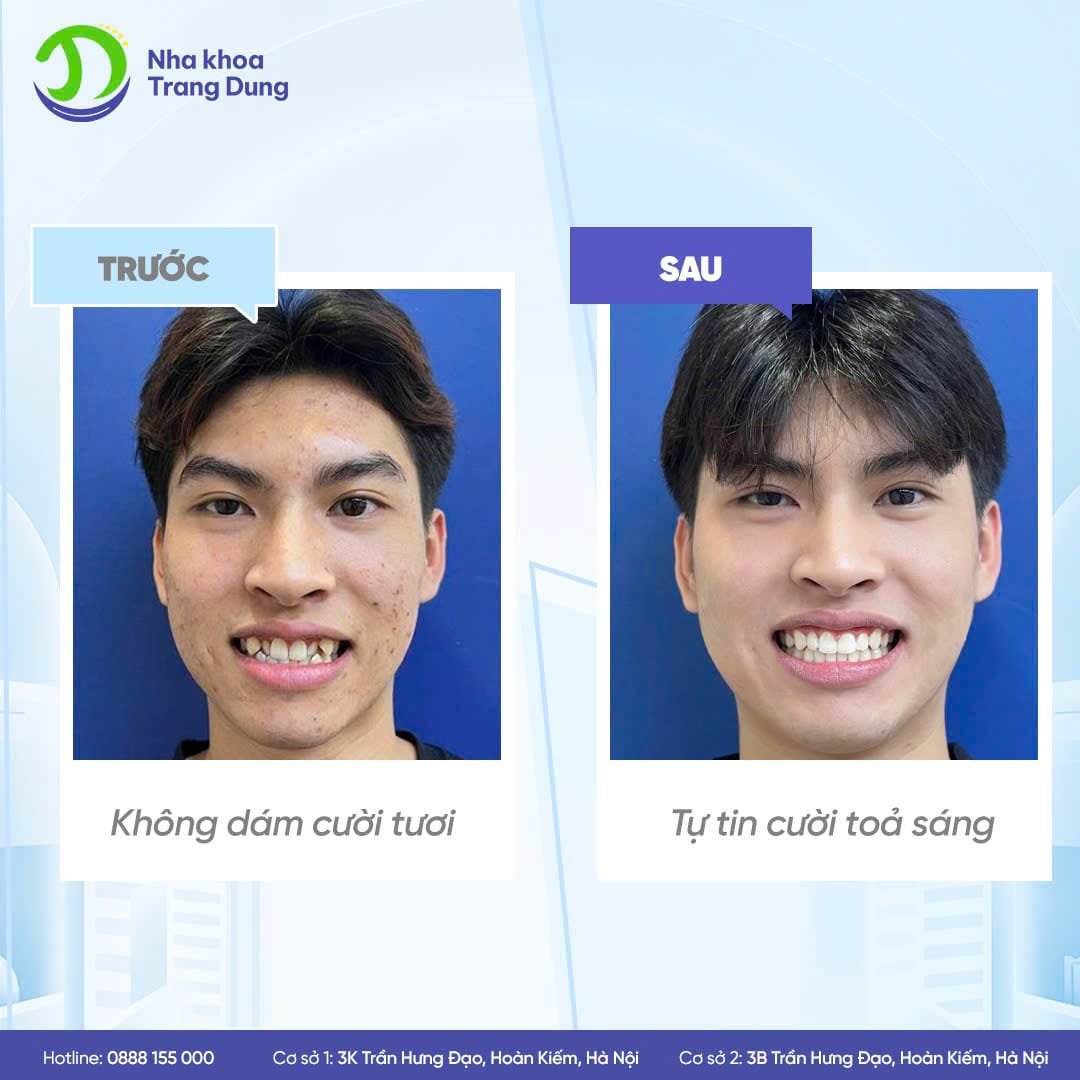 Các Kiểu Niềng Răng Nào Phù Hợp Với Bạn? Sự Thật Khiến Ai Cũng Ngỡ Ngàng! Niềng răng uy tín Hà Nội