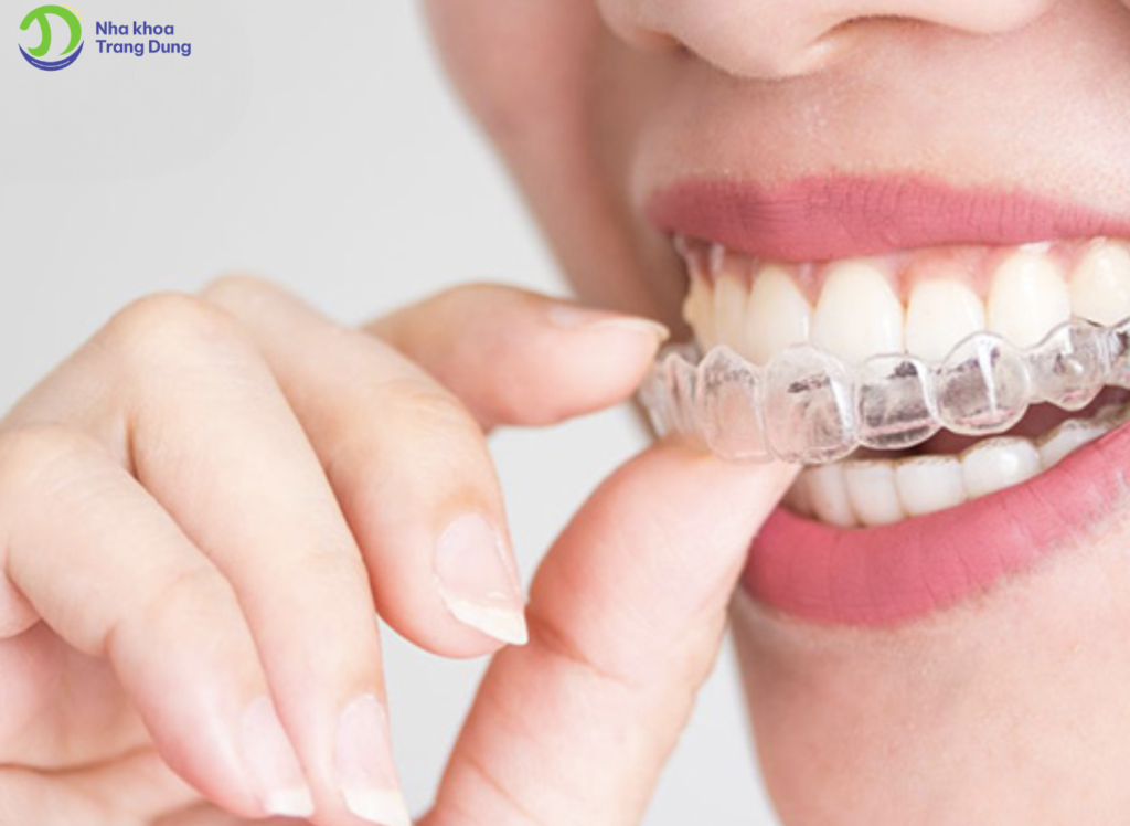 Invisalign là gì và cơ chế hoạt động của nó?