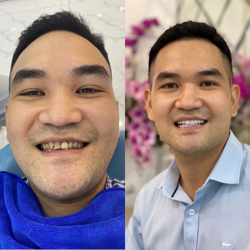 Bọc Răng Sứ Cho Răng Sâu