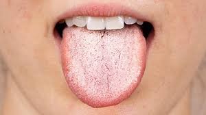 Cách Làm Sạch Lưỡi Bị Trắng Và Các Biện Pháp Phòng Ngừa cach lam sach luoi bi trang