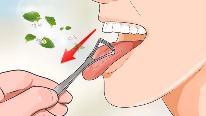 Cách Làm Sạch Lưỡi Bị Trắng Và Các Biện Pháp Phòng Ngừa cach lam sach luoi bi trang