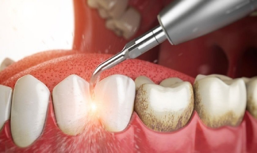 Lợi Ích Của Việc Lấy Cao Răng Có Đau Không Định Kỳ Cho Răng Miệng lay cao rang co dau khong