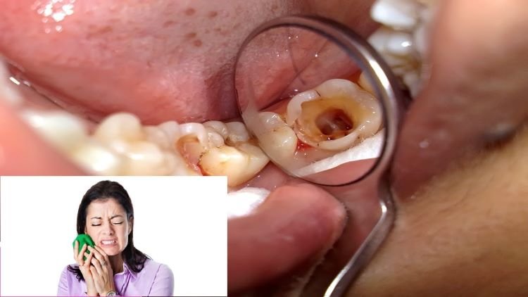 Cách Trị Nhức Răng Có Lỗ Kết Hợp Chăm Sóc Răng Miệng Hiệu Quả Tình trạng răng có lỗ hổng gây đau nhức
