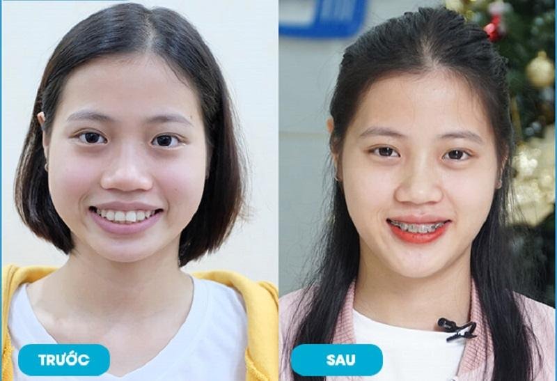 Niềng răng mắc cài trong suốt Hình ảnh trước và sau khi niềng răng