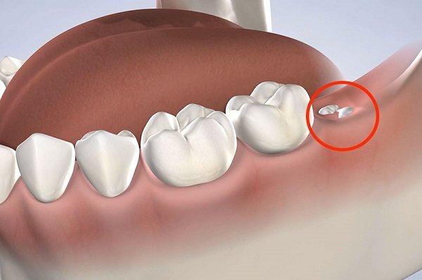 Dấu Hiệu Răng Khôn Mọc Lệch Và Cách Nhận Biết Sớm Để Phòng Ngừa dấu hiệu răng khôn mọc lệch