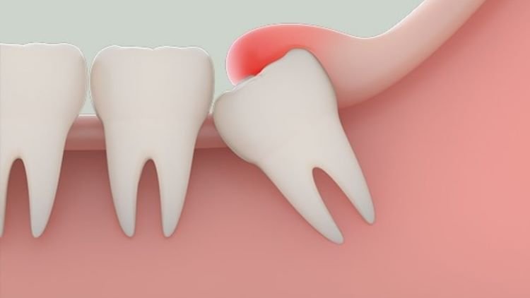 Dấu hiệu răng khôn mọc lệch cần biết và cách xử lý hiệu quả dấu hiệu răng khôn mọc lệch