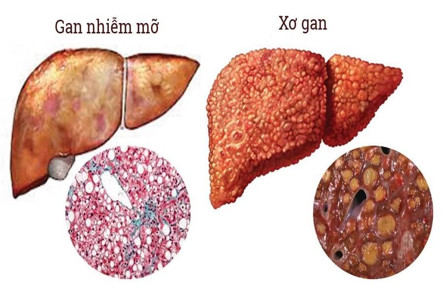 Gan nhiễm mỡ có nguy hiểm không? Cảnh báo sớm để bảo vệ lá gan Gan nhiễm mỡ có nguy hiểm không