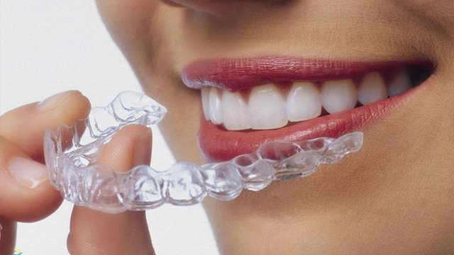 Các Kiểu Niềng Răng Nào Phù Hợp Với Bạn? Sự Thật Khiến Ai Cũng Ngỡ Ngàng! Niềng mắc cài trong suốt invisalign