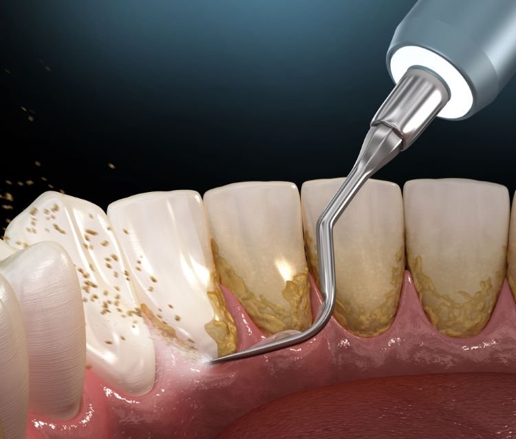 Lấy cao răng có đau không? Những điều nên biết trước khi thực hiện Lấy cao răng có đau không