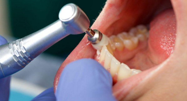 Lấy cao răng có đau không? Những điều nên biết trước khi thực hiện Lấy cao răng có bị đau không