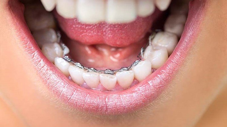 Các Kiểu Niềng Răng Nào Phù Hợp Với Bạn? Sự Thật Khiến Ai Cũng Ngỡ Ngàng! Niềng răng mặt lưỡi