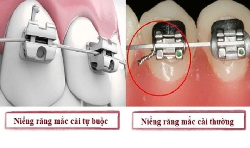 Niềng Răng Mắc Cài Tự Buộc Là Gì? Ưu Nhược Điểm & Chi Phí Chi Tiết Niềng răng mắc cài tự động