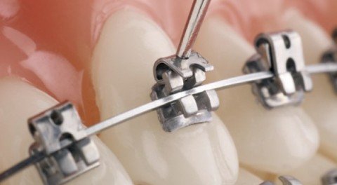 Các Kiểu Niềng Răng Nào Phù Hợp Với Bạn? Sự Thật Khiến Ai Cũng Ngỡ Ngàng! Niềng mắc cài tự buộc