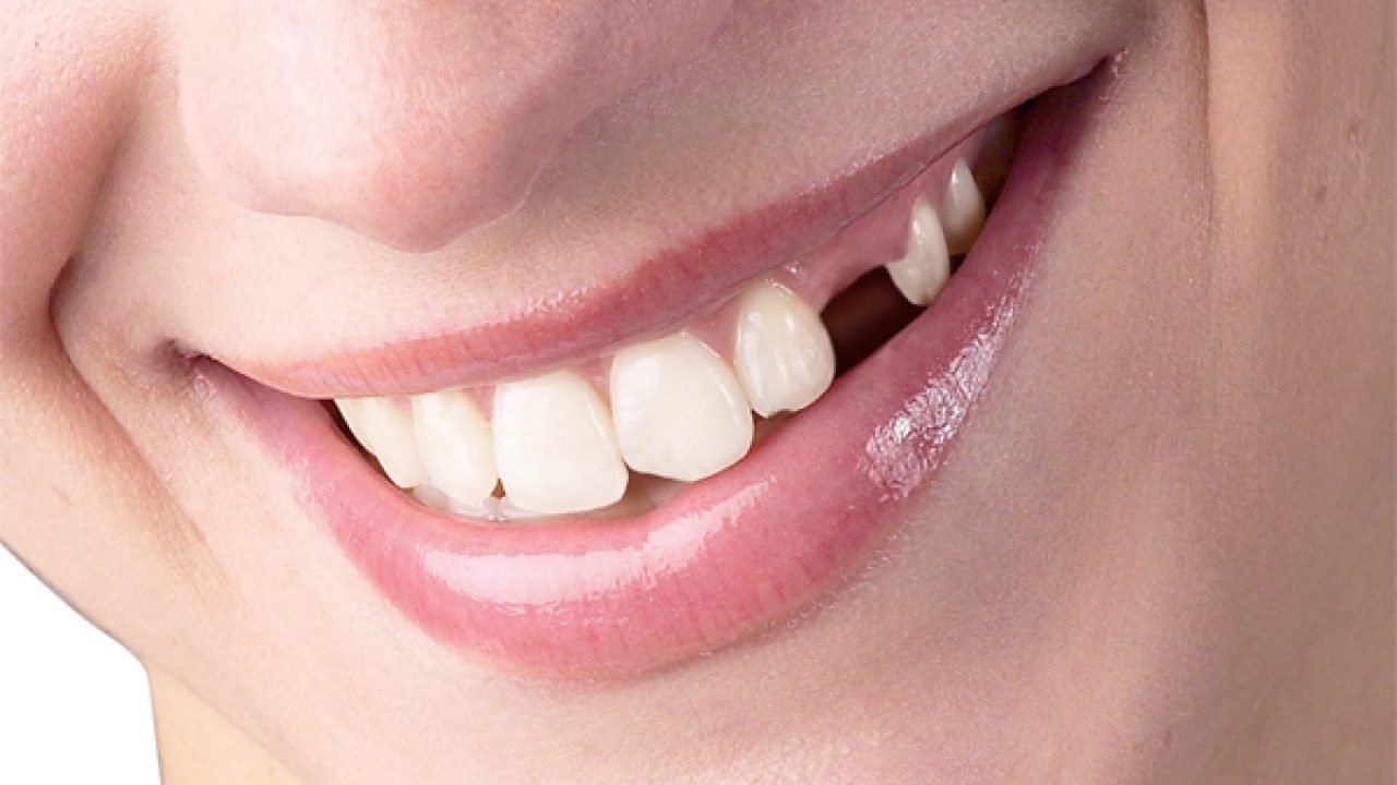 Nằm mơ thấy gãy răng có ý nghĩa gì? Điềm báo tốt hay xấu? Nằm mơ thấy gãy răng