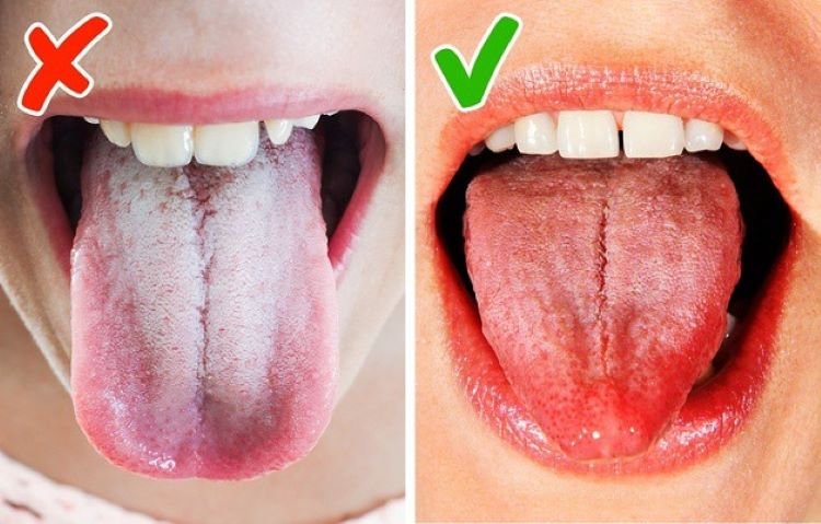Cách Làm Sạch Lưỡi Bị Trắng Và Các Biện Pháp Phòng Ngừa Nguyên nhân khiến lưỡi bị trắng