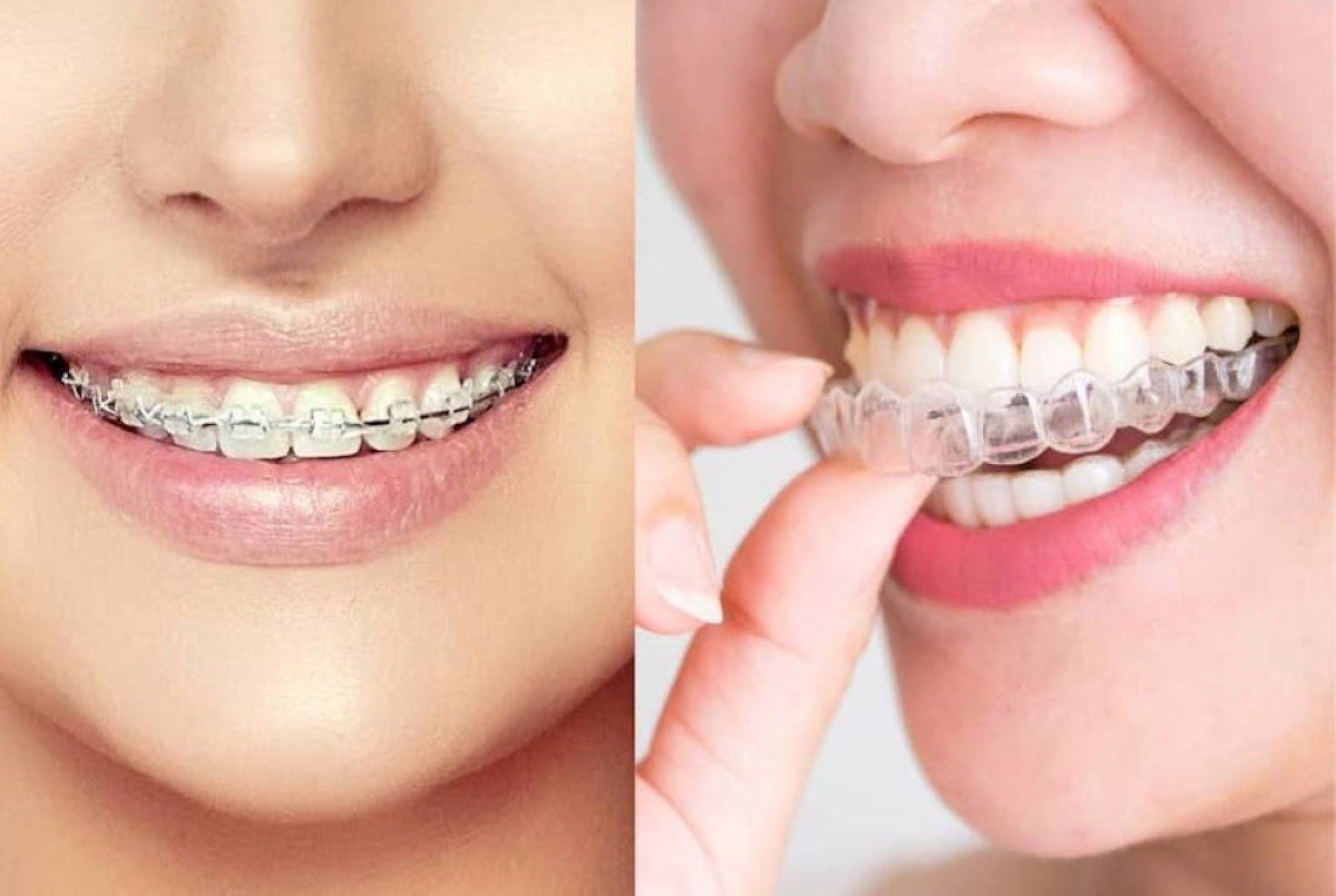 Nha khoa Trang Dung Niềng răng Invisalign