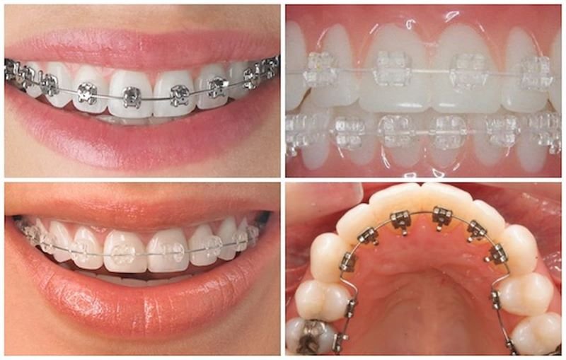 Niềng Răng Mắc Cài Tự Động Là Gì? Có Những Loại Nào? Niềng răng mắc cài sứ và kim loại tự buộc