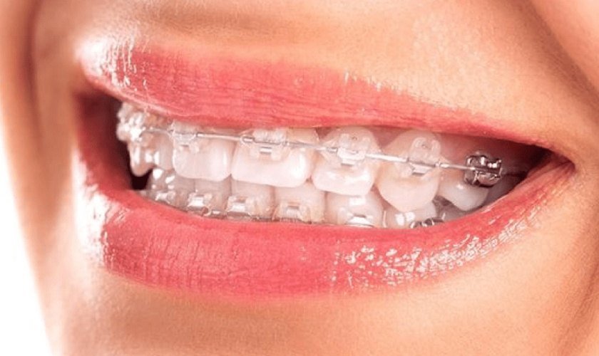 Niềng răng mắc cài trong suốt Niềng răng mắc cài trong suốt