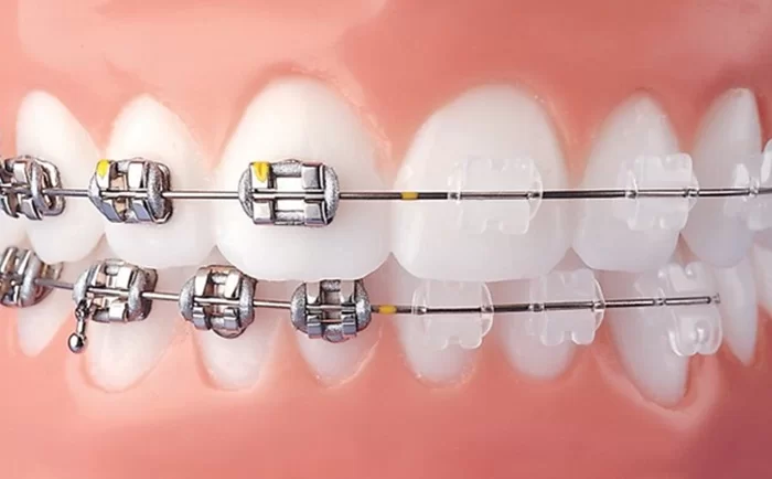 Niềng răng mắc cài trong suốt Niềng răng mắc cài kim loại và niềng mắc cái trong suốt