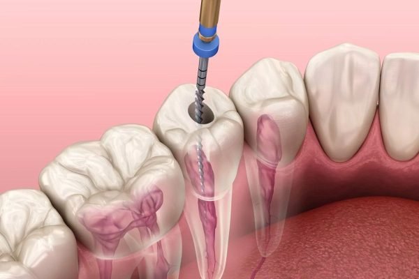 Điều Trị Tủy Răng Hà Nội Giá Bao Nhiêu? Những Thông Tin Cần Biết Điều trị tủy răng Hà Nội