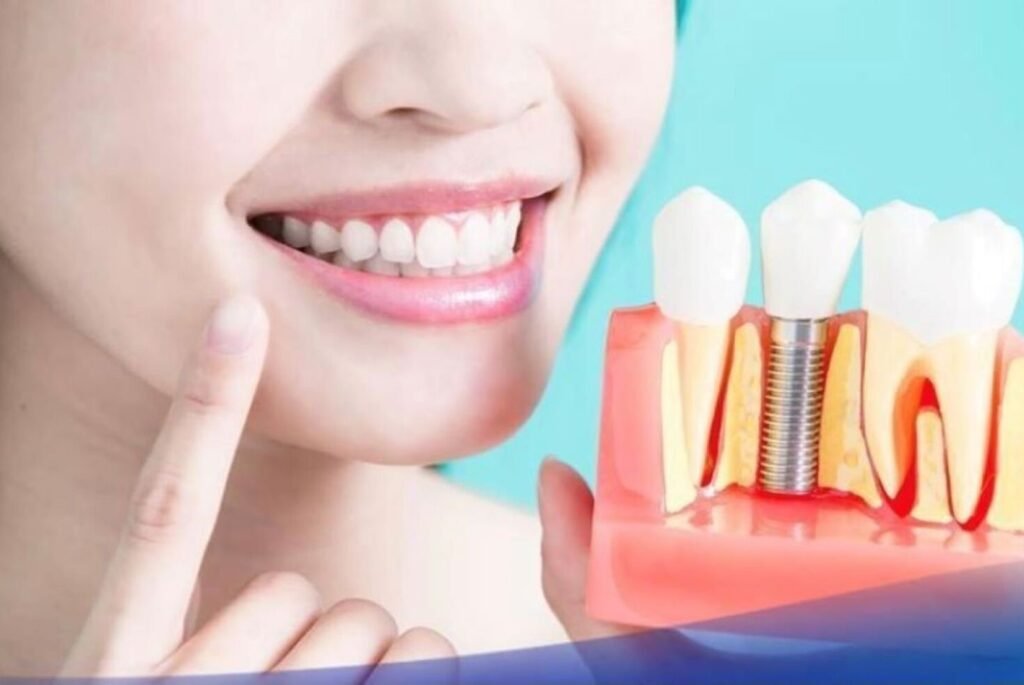 Trồng răng Implant