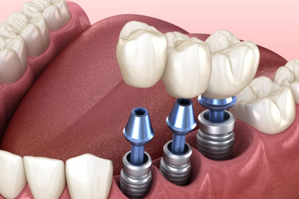 Trồng răng hàm implant giá bao nhiêu