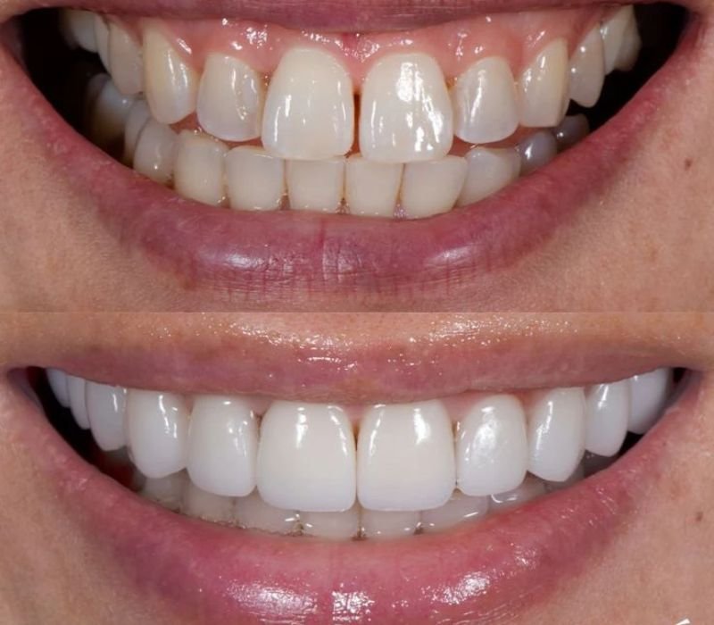 Làm răng sứ thẩm mỹ trả góp lãi suất 0%, dễ dàng, nhanh chóng. Làm răng sứ thẩm mỹ trả góp