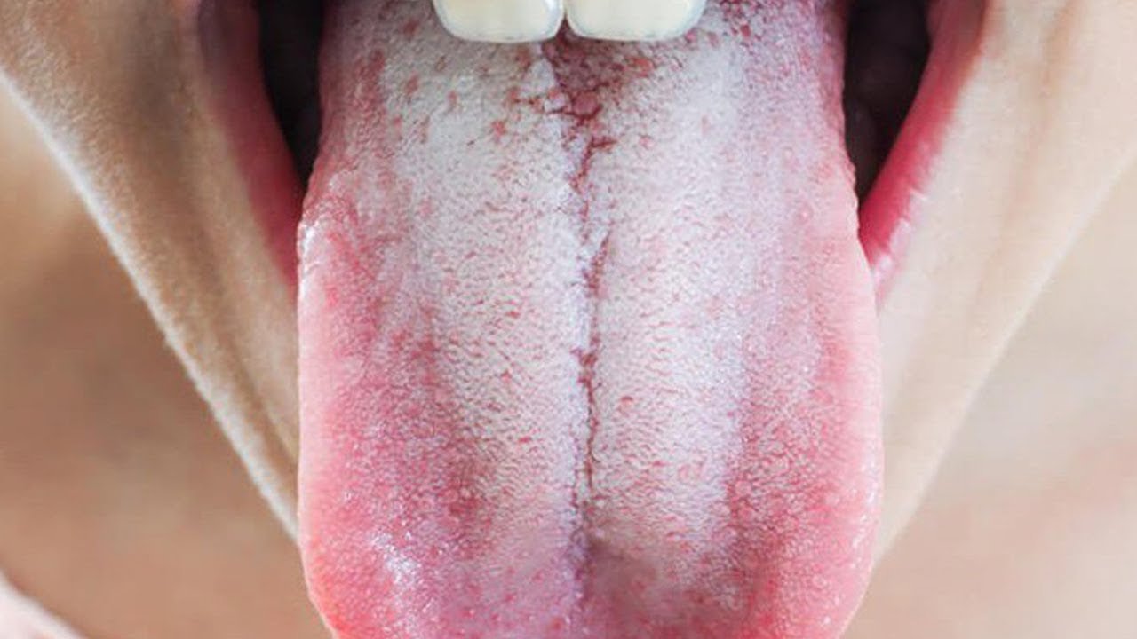 Cách làm sạch lưỡi bị trắng