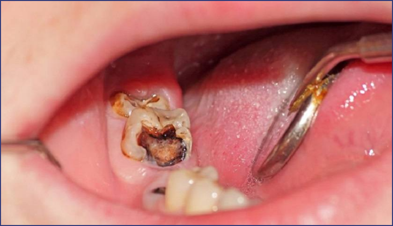 Cách trị nhức răng có lỗ tại nhà và khi nào cần đến nha sĩ cach tri nhuc rang co lo 1