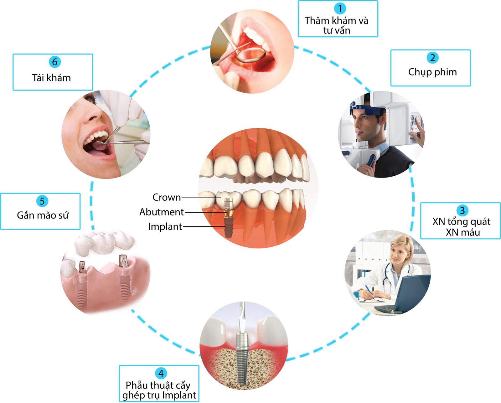 Cấy ghép implant giá bao nhiêu? Cập nhật chi phí mới nhất 2025 cay ghep implant gia bao nhieu 1 1
