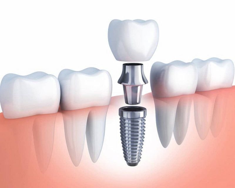 Cấy ghép implant giá bao nhiêu? Cập nhật chi phí mới nhất 2025 cay ghep implant gia bao nhieu 1 3